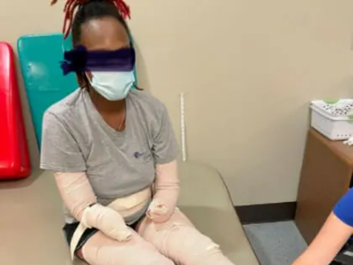 PHOTOS: 32-Year-Old Mum-Of-Three Has Hands and Feet Amputated After Getting COVID