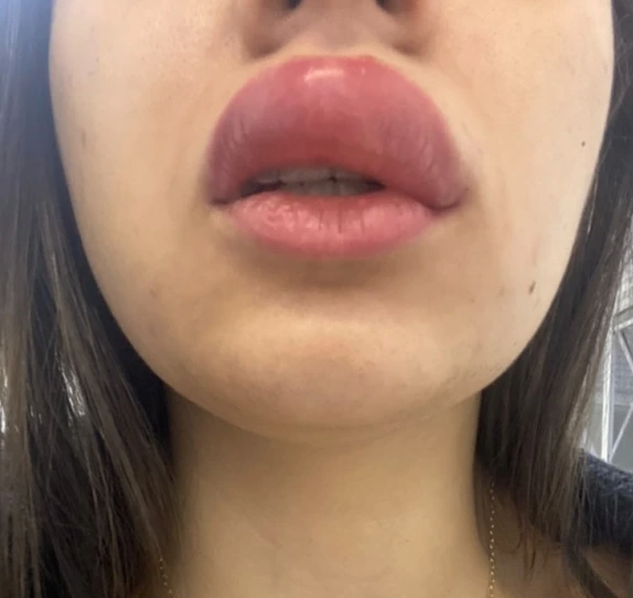swollen lips